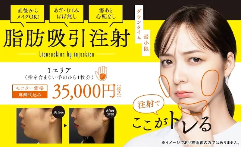 湘南美容クリニックの小顔用脂肪吸引注射モニター価格